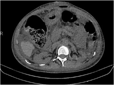Case Report: Abdominal Wall Reconstruction in a High-Risk Patient With Incisional Hernia and Complications From Oncological Treatment